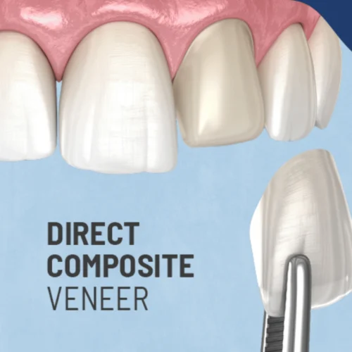 Composite Veneer Composite Veneer