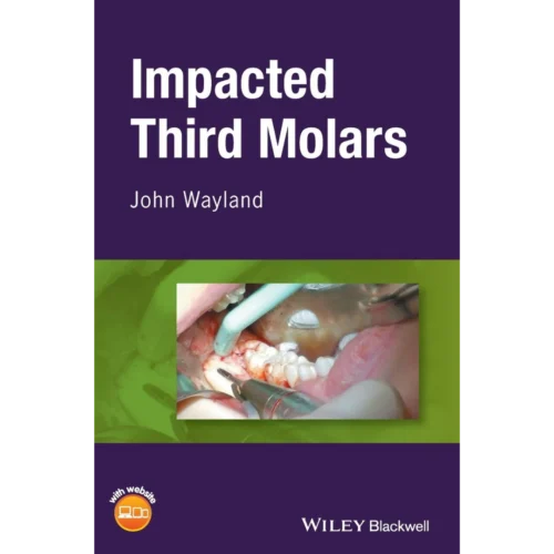 Impacted Third Molars Impacted Third Molars