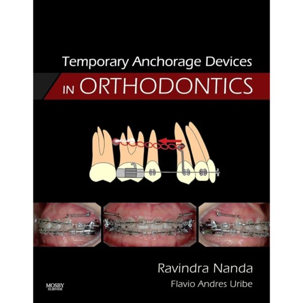 Temporary Anchorage Devices in Orthodontics
