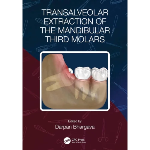 Transalveolar Extraction of the Mandibular Third Molars Transalveolar Extraction of the Mandibular Third Molars