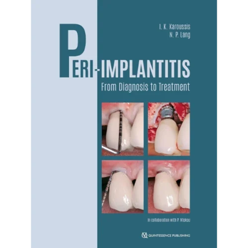 Peri-Implantitis From Diagnosis to Treatment Peri-Implantitis: From Diagnosis to Treatment