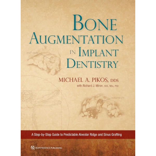 Bone Augmentation in Implant Dentistry: A Step-by-step Guide to Predictable Alveolar Ridge and Sinus Grafting