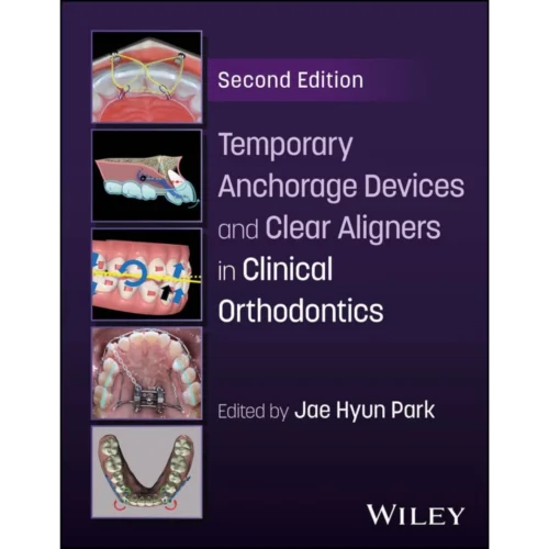 Temporary Anchorage Devices and Clear Aligners in Clinical Orthodontics Temporary Anchorage Devices and Clear Aligners in Clinical Orthodontics
