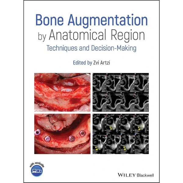 Bone Augmentation by Anatomical Region: Techniques and Decision-Making