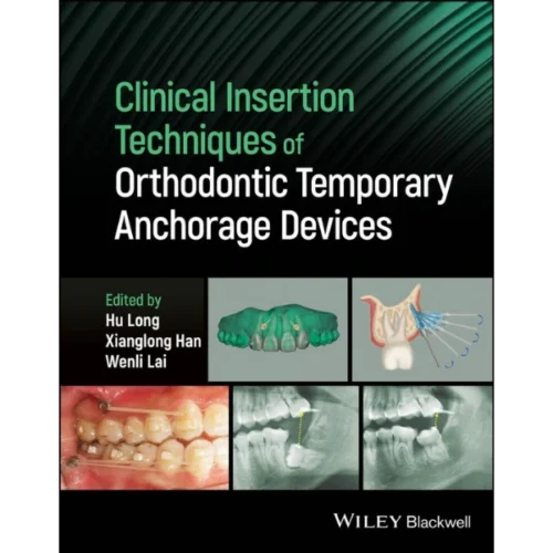Clinical Insertion Techniques of Orthodontic Temporary Anchorage Devices Clinical Insertion Techniques of Orthodontic Temporary Anchorage Devices