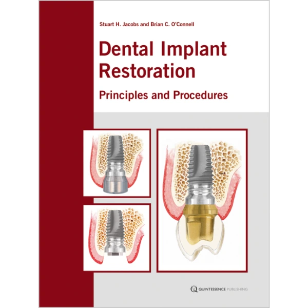 Dental Implant Restoration Principles and Procedures