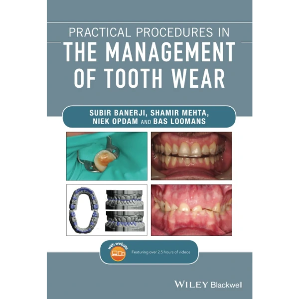 Practical Procedures in the Management of Tooth Wear